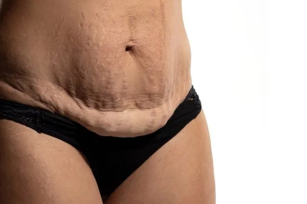The Science of Skin Tightening 1 The science behind skin tightening Guildford picture of a woman's sagging skin on the stomach